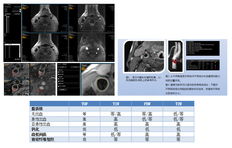 PLAQUE LAB颈部动脉斑块分析实验室