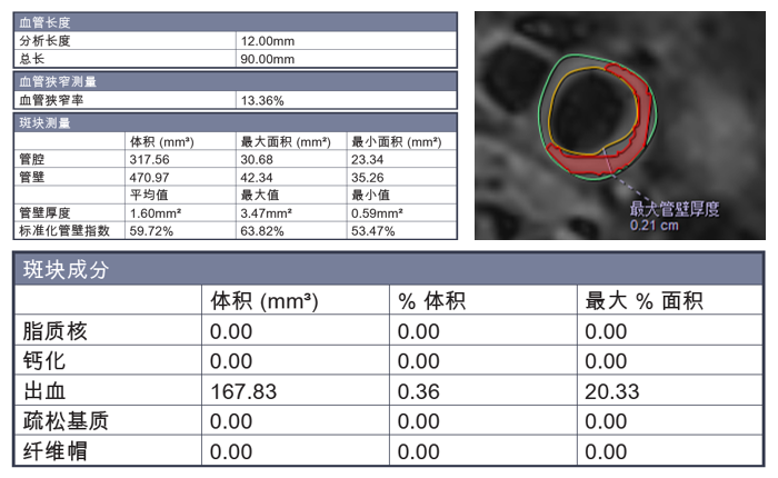 PLAQUE LAB头颈一体动脉斑块分析实验室